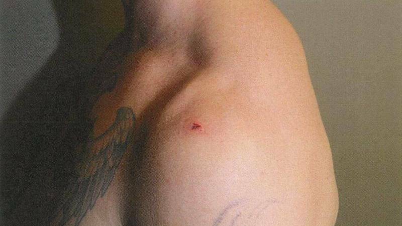 The puncture wound sustained by Constable Rolfe from being stabbed with scissors. Picture: Supreme Court of the NT