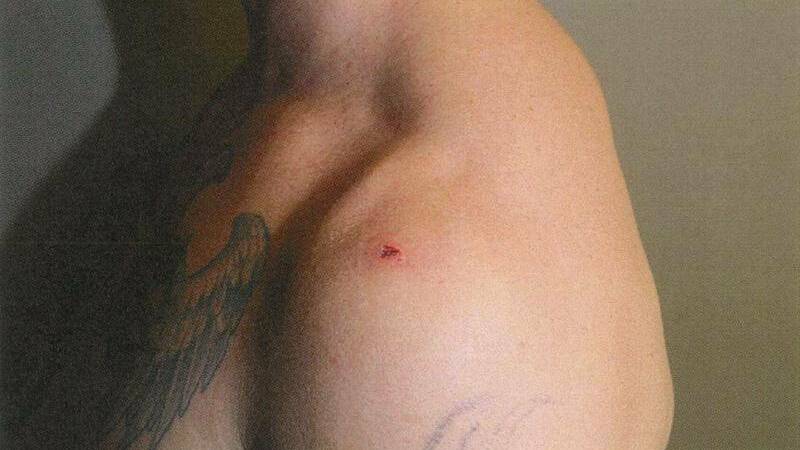 The wound Zachary Rolfe sustained from a pair of surgical scissors used by Kumanjayi Walker. Picture: NT Supreme Court