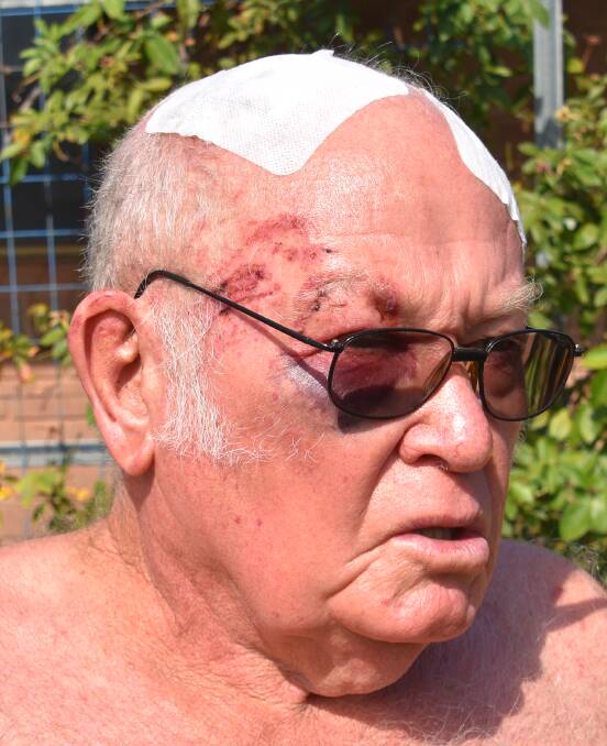 BATTERED: Bevan Gitsham has been left bruised and battered, needing almost 20 stiches in his head. 