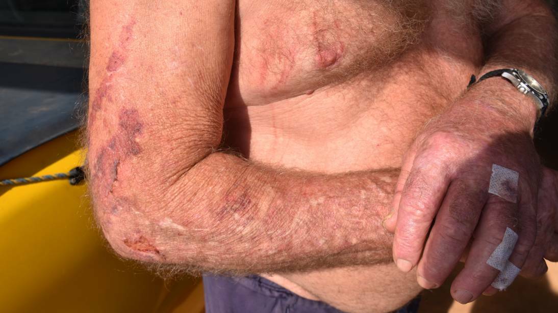 A 78-year-old Katherine man was rushed to Katherine Hospital with large lacerations to his head and cuts and bruises covering his face and body following an attack in his home. 