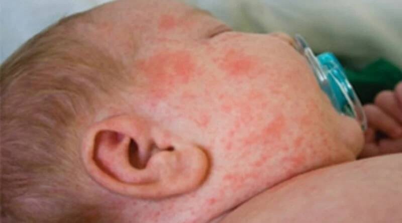There are already two cases of measles in Darwin. File picture.
