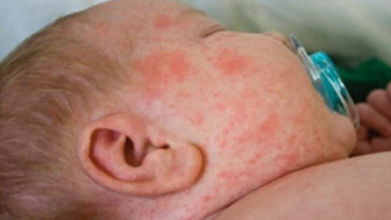  Cases of measles are currently present in Australia and much of the rest of the world.