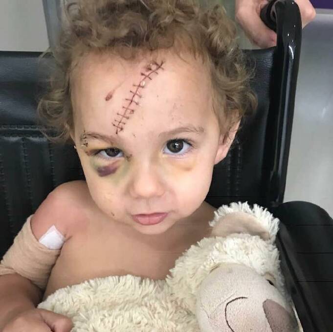 Two-year-old Logan Grieve suffered horrific injuries from the dog bite. Pictures: supplied.