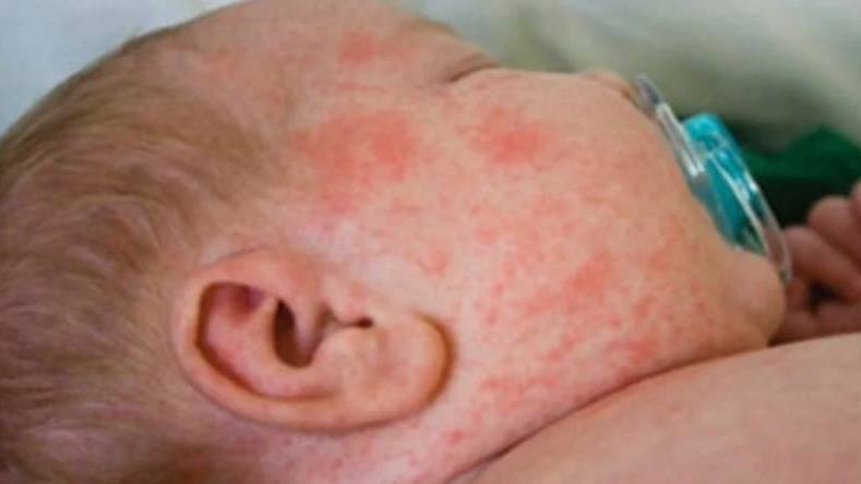 The NT measles outbreak is over but Territorians are warned not to be complacent.