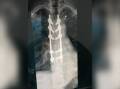 An X-ray of Alex Ballhausen's spine.